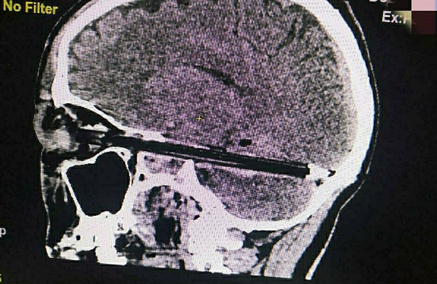 СК начал проверку после смерти пациента с шариковой ручкой в мозгу 